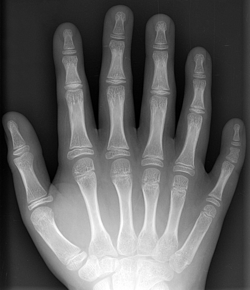 Radiografía de una mano derecha con duplicación de uno de sus dedos. Original work by author, CC BY-SA 3.0, https://commons.wikimedia.org/w/index.php?curid=120503